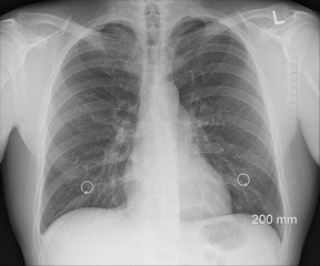 Lung x-ray - Is Scuba Diving Hard On Your Body small