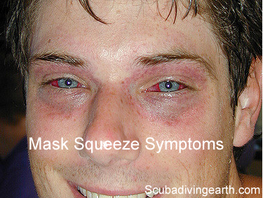 Mask squeeze symptoms